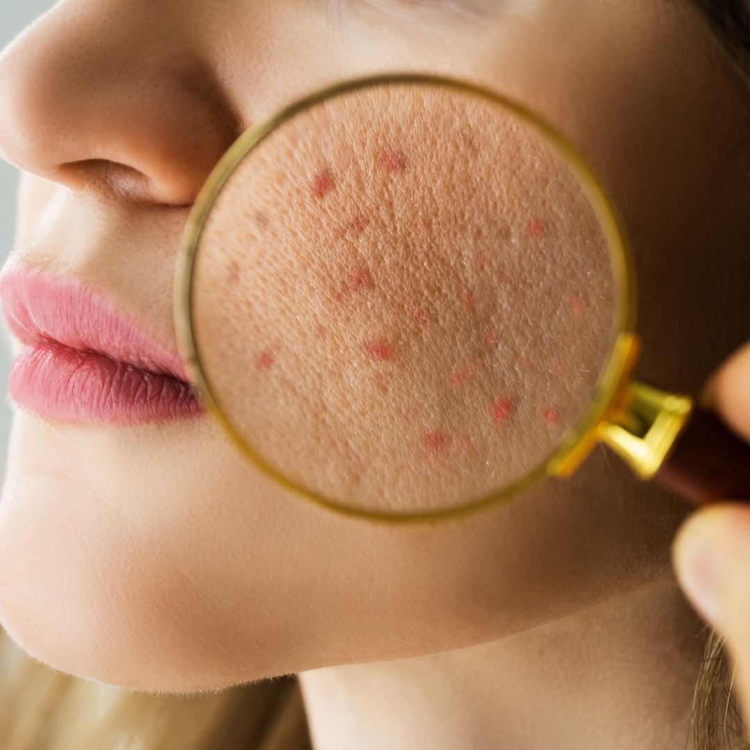 Acne and Oil Control